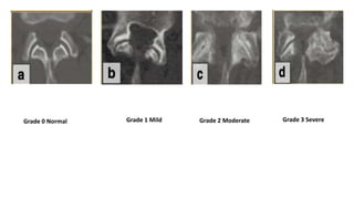 Grade 0 Normal Grade 3 Severe
Grade 2 Moderate
Grade 1 Mild
 