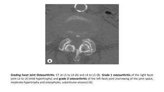 Grading Facet Joint Osteoarthritis. CT at L3 to L4 (A) and L4 to L5 (B). Grade 1 osteoarthritis of the right facet
joint L3 to L4 (mild hypertrophy) and grade 2 osteoarthritis of the left facet joint (narrowing of the joint space,
moderate hypertrophy and osteophytes, subarticular erosion) (A).
 