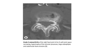 Grade 3 osteoarthritis of the right facet joint L4 to L5 with joint space
narrowing, hypertrophy of the articular processes, large osteophytes
and subarticular bone erosions (B).
 