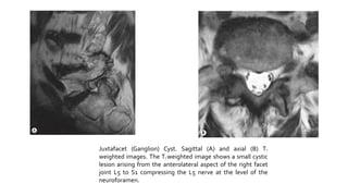 Juxtafacet (Ganglion) Cyst. Sagittal (A) and axial (B) T2
weighted images. The T2 weighted image shows a small cystic
lesion arising from the anterolateral aspect of the right facet
joint L5 to S1 compressing the L5 nerve at the level of the
neuroforamen.
 