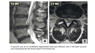 A synovial cyst at L4–L5.Bilateral degenerated facet joint effusions with a left-sided synovial
cyst compressing the left dorsal aspect of the thecal sac
 