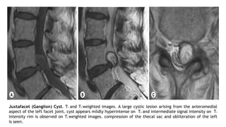 Juxtafacet (Ganglion) Cyst. T1 and T2 weighted images. A large cystic lesion arising from the anteromedial
aspect of the left facet joint. cyst appears mildly hyperintense on T2 and intermediate signal intensity on T1
intensity rim is observed on T2 weighted images. compression of the thecal sac and obliteration of the left
is seen.
 