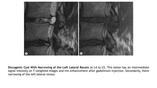 Discogenic Cyst With Narrowing of the Left Lateral Recess at L4 to L5. This lesion has an intermediate
signal intensity on T1 weighted images and rim enhancement after gadolinium injection. Secondarily, there
narrowing of the left lateral recess.
 