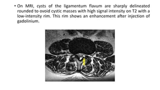 • On MRI, cysts of the ligamentum flavum are sharply delineated
rounded to ovoid cystic masses with high signal intensity on T2 with a
low-intensity rim. This rim shows an enhancement after injection of
gadolinium.
 