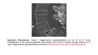 Baastrup’s Phenomenon. Grade 2 degenerative spondylolisthesis at the L5 to S1 level,
malalignment of the spinous processes with anterior slip of the L4 spinous process relative to L5
type 3 degenerative spondylolisthesis and allows differentiation from isthmic spondylolisthesis.
 