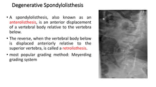 Degenerative Spondylolisthesis
• A spondylolisthesis, also known as an
anterolisthesis, is an anterior displacement
of a vertebral body relative to the vertebra
below.
• The reverse, when the vertebral body below
is displaced anteriorly relative to the
superior vertebra, is called a retrolisthesis.
• most popular grading method: Meyerding
grading system
 