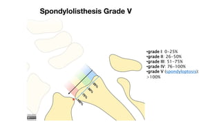 •grade I: 0-25%
•grade II: 26-50%
•grade III: 51-75%
•grade IV: 76-100%
•grade V (spondyloptosis):
>100%
 