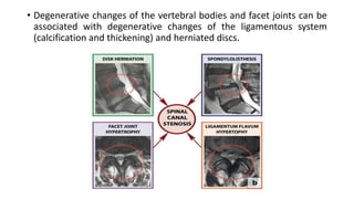 • Degenerative changes of the vertebral bodies and facet joints can be
associated with degenerative changes of the ligamentous system
(calcification and thickening) and herniated discs.
 