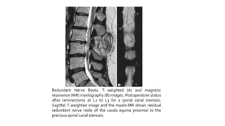 Redundant Nerve Roots. T2 weighted (A) and magnetic
resonance (MR) myelography (B) images. Postoperative status
after laminectomy at L2 to L3 for a spinal canal stenosis.
Sagittal T2 weighted image and the myelo-MR shows residual
redundant nerve roots of the cauda equina proximal to the
previous spinal canal stenosis.
 