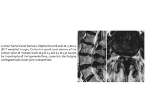 Lumbar Spinal Canal Stenosis. Sagittal (A) and axial at L3 to L4
(B) T2 weighted images. Concentric spinal canal stenosis of the
lumbar spine at multiple levels (L3 to L4 and L4 to L5) caused
by hypertrophy of the ligamenta flava, concentric disc bulging
and hypertrophic facet joint osteoarthritis.
 