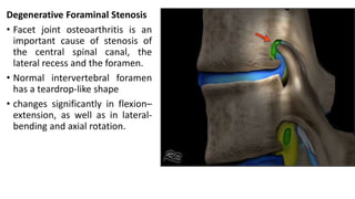 Degenerative Foraminal Stenosis
• Facet joint osteoarthritis is an
important cause of stenosis of
the central spinal canal, the
lateral recess and the foramen.
• Normal intervertebral foramen
has a teardrop-like shape
• changes significantly in flexion–
extension, as well as in lateral-
bending and axial rotation.
 