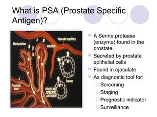 Free/Total PSA Ratio:
A Way to Improve Specificity
Prostate cancer maybe
associated with more
protein-bound PSA
(less fre...