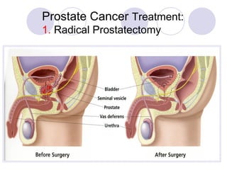 Pathology of prostate