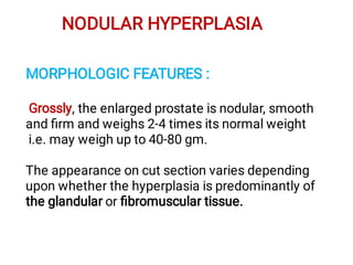 NODULAR HYPERPLASIA
MORPHOLOGIC FEATURES :
Grossly, the enlarged prostate is nodular, smooth
and ﬁrm and weighs 2-4 times its normal weight
i.e. may weigh up to 40-80 gm.
The appearance on cut section varies depending
upon whether the hyperplasia is predominantly of
the glandular or ﬁbromuscular tissue.
 
