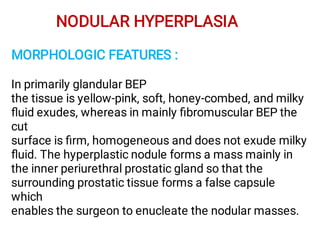 NODULAR HYPERPLASIA
MORPHOLOGIC FEATURES :
In primarily glandular BEP
the tissue is yellow-pink, soft, honey-combed, and milky
ﬂuid exudes, whereas in mainly ﬁbromuscular BEP the
cut
surface is ﬁrm, homogeneous and does not exude milky
ﬂuid. The hyperplastic nodule forms a mass mainly in
the inner periurethral prostatic gland so that the
surrounding prostatic tissue forms a false capsule
which
enables the surgeon to enucleate the nodular masses.
 