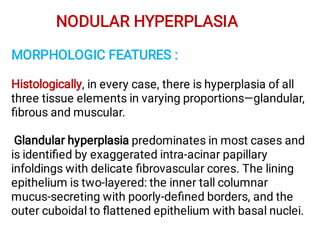 NODULAR HYPERPLASIA
MORPHOLOGIC FEATURES :
Histologically, in every case, there is hyperplasia of all
three tissue elements in varying proportions—glandular,
ﬁbrous and muscular.
Glandular hyperplasia predominates in most cases and
is identiﬁed by exaggerated intra-acinar papillary
infoldings with delicate ﬁbrovascular cores. The lining
epithelium is two-layered: the inner tall columnar
mucus-secreting with poorly-deﬁned borders, and the
outer cuboidal to ﬂattened epithelium with basal nuclei.
 