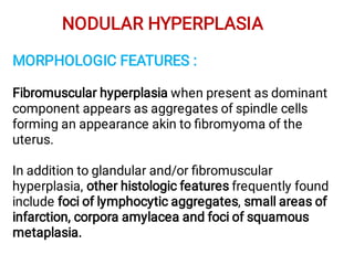 NODULAR HYPERPLASIA
MORPHOLOGIC FEATURES :
Fibromuscular hyperplasia when present as dominant
component appears as aggregates of spindle cells
forming an appearance akin to ﬁbromyoma of the
uterus.
In addition to glandular and/or ﬁbromuscular
hyperplasia, other histologic features frequently found
include foci of lymphocytic aggregates, small areas of
infarction, corpora amylacea and foci of squamous
metaplasia.
 