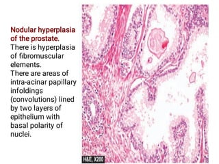 Nodular hyperplasia
of the prostate.
There is hyperplasia
of ﬁbromuscular
elements.
There are areas of
intra-acinar papillary
infoldings
(convolutions) lined
by two layers of
epithelium with
basal polarity of
nuclei.
 