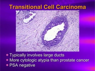 Prostate Pathophysiology23.ppt prostate cancer prostatic hyperplasia