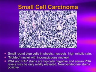 Prostate Pathophysiology23.ppt prostate cancer prostatic hyperplasia