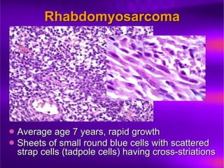 Prostate Pathophysiology23.ppt prostate cancer prostatic hyperplasia