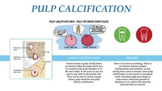 PULP CALCIFICATION
Various forms of pulp calcifications
are found within the pulp which may
be located in the pulp chamber...