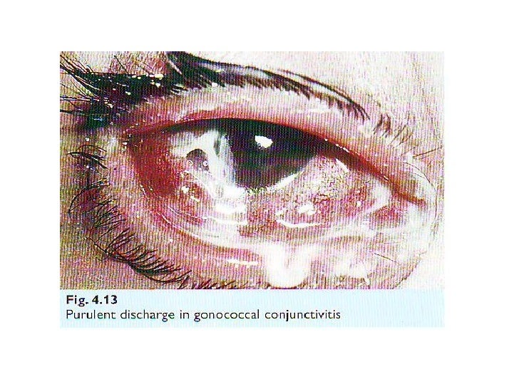 Pathology of the conjunctiva baguio 2012