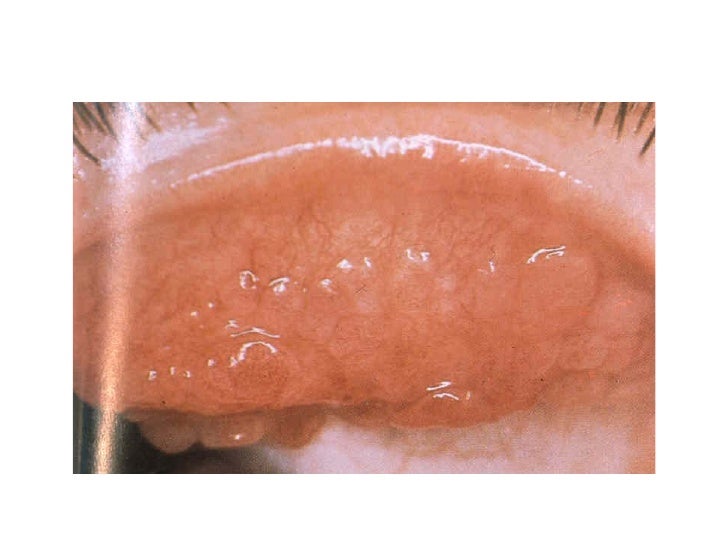 Pathology of the conjunctiva baguio 2012