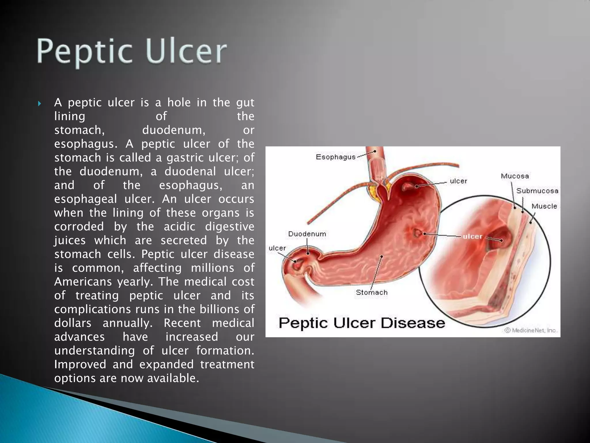 A peptic ulcer is a hole in the gut lining of the stomach, duodenum, or esophagus. A peptic ulcer of the stomach is called a gastric ulcer; of the duodenum, a duodenal ulcer; and of the esophagus, an esophageal ulcer. An ulcer occurs when the lining of these organs is corroded by the acidic digestive juices which are secreted by the stomach cells. Peptic ulcer disease is common, affecting millions of Americans yearly. The medical cost of treating peptic ulcer and its complications runs in the billions of dollars annually. Recent medical advances have increased our understanding of ulcer formation. Improved and expanded treatment options are now available.Peptic Ulcer