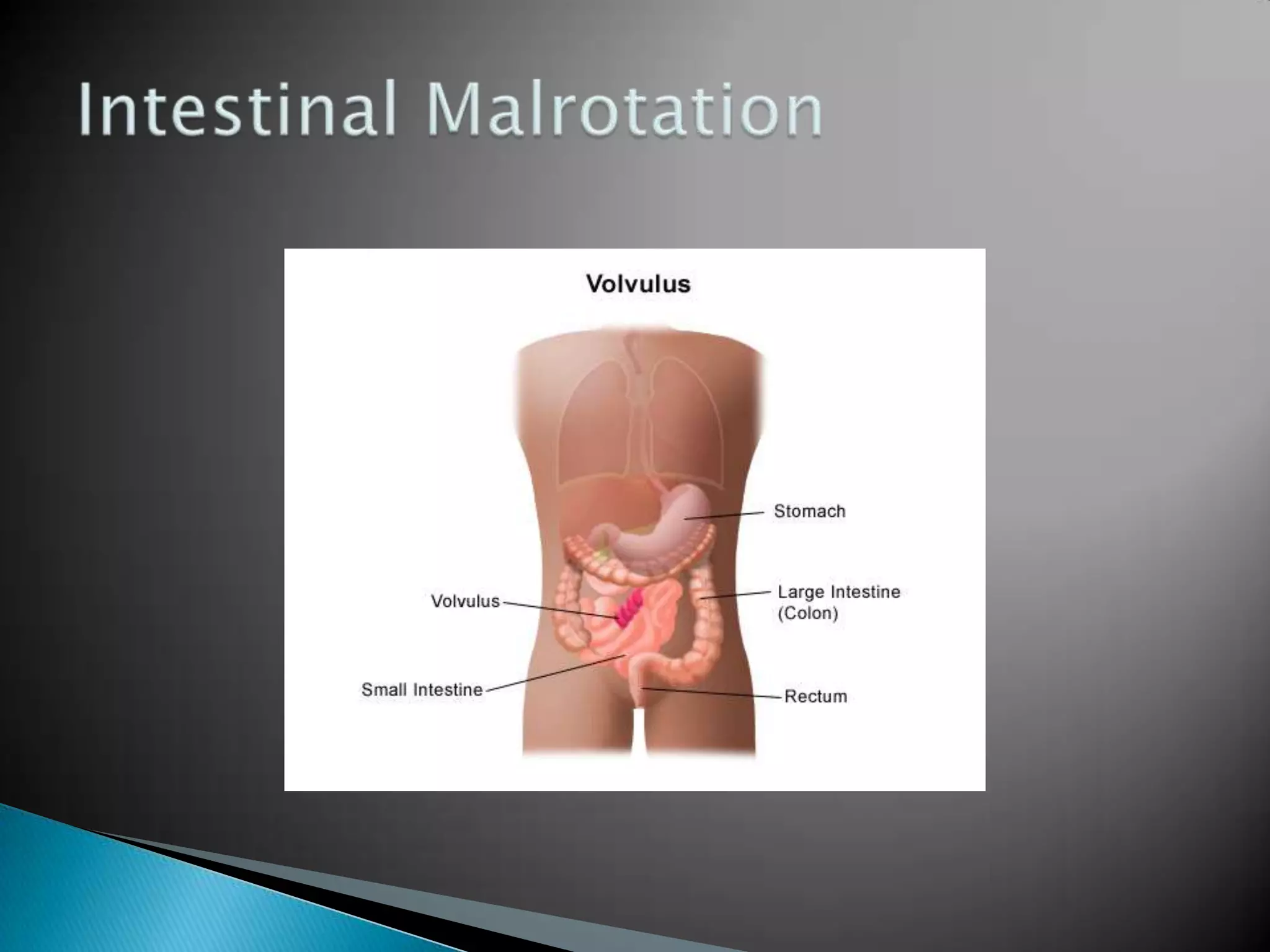 Intestinal Malrotation