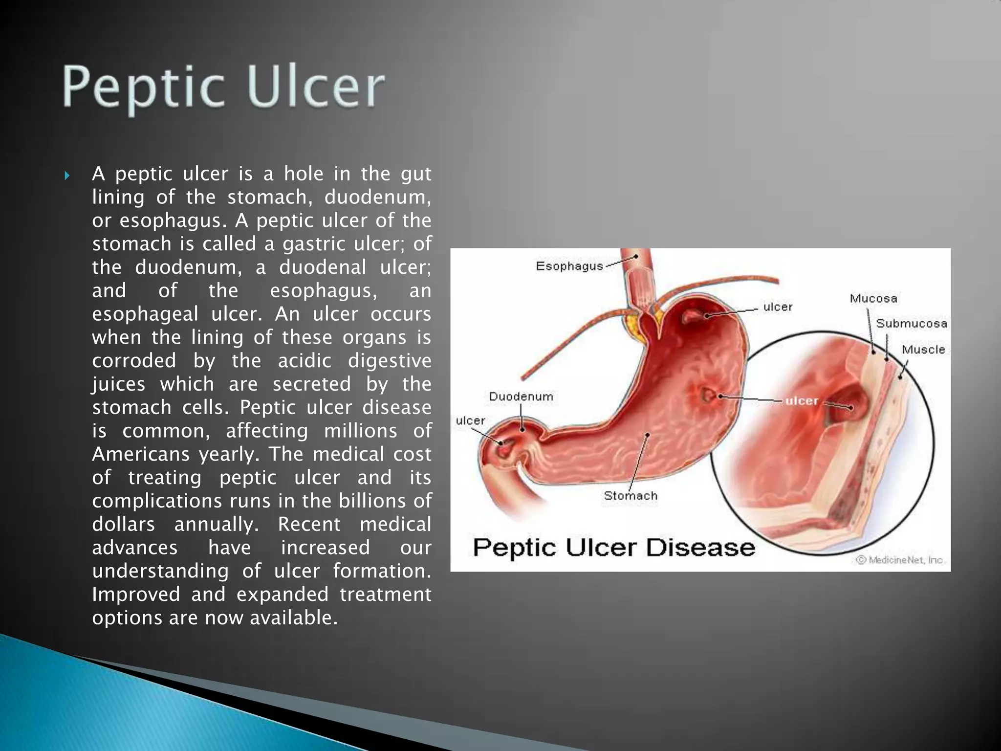    A peptic ulcer is a hole in the gut
    lining of the stomach, duodenum,
    or esophagus. A peptic ulcer of the
    stomach is called a gastric ulcer; of
    the duodenum, a duodenal ulcer;
    and    of   the    esophagus,     an
    esophageal ulcer. An ulcer occurs
    when the lining of these organs is
    corroded by the acidic digestive
    juices which are secreted by the
    stomach cells. Peptic ulcer disease
    is common, affecting millions of
    Americans yearly. The medical cost
    of treating peptic ulcer and its
    complications runs in the billions of
    dollars annually. Recent medical
    advances    have increased       our
    understanding of ulcer formation.
    Improved and expanded treatment
    options are now available.
 