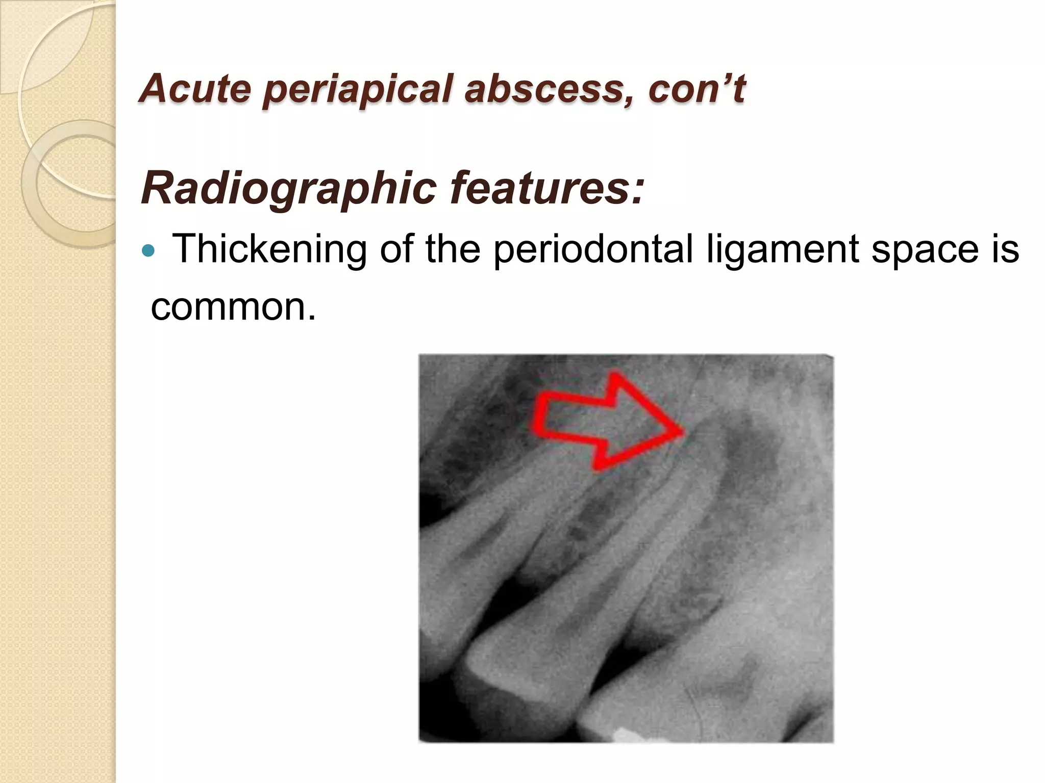 Acute periapical abscess, con’t

Radiographic features:
Thickening of the periodontal ligament space is
common.
 