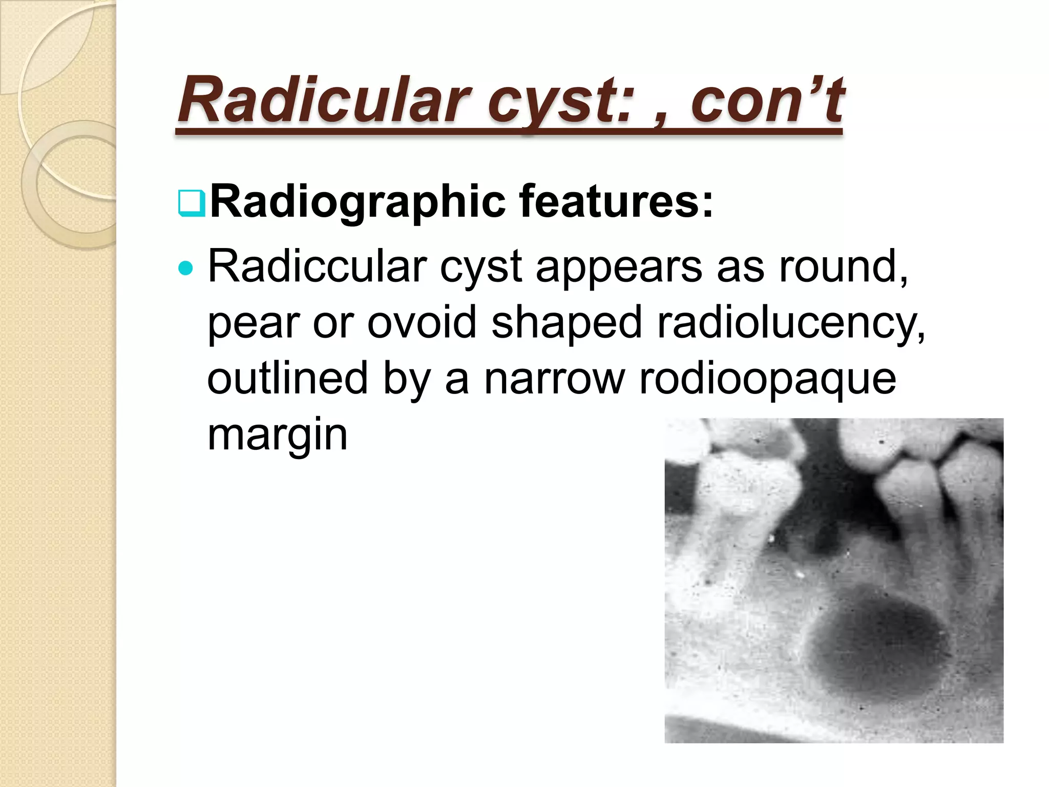 Radicular cyst: , con’t
Radiographic    features:
 Radiccular cyst appears as round,
  pear or ovoid shaped radiolucency,
  outlined by a narrow rodioopaque
  margin
 