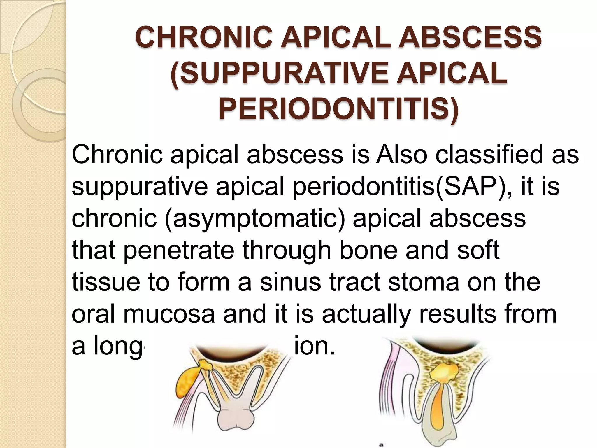 CHRONIC APICAL ABSCESS
       (SUPPURATIVE APICAL
          PERIODONTITIS)
Chronic apical abscess is Also classified as
suppurative apical periodontitis(SAP), it is
chronic (asymptomatic) apical abscess
that penetrate through bone and soft
tissue to form a sinus tract stoma on the
oral mucosa and it is actually results from
a long-standing lesion.
 