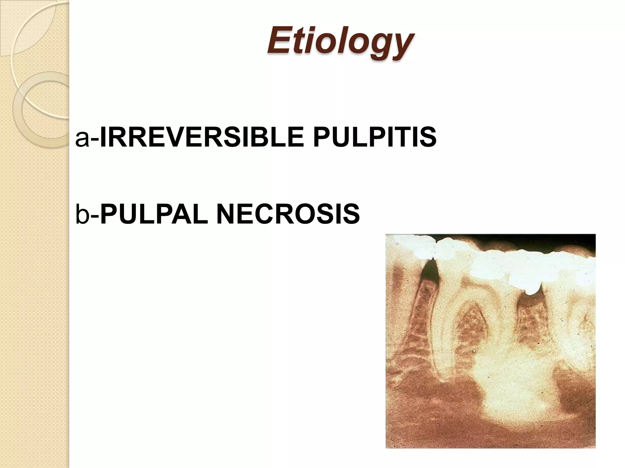 Etiology

a-IRREVERSIBLE PULPITIS

b-PULPAL NECROSIS
 