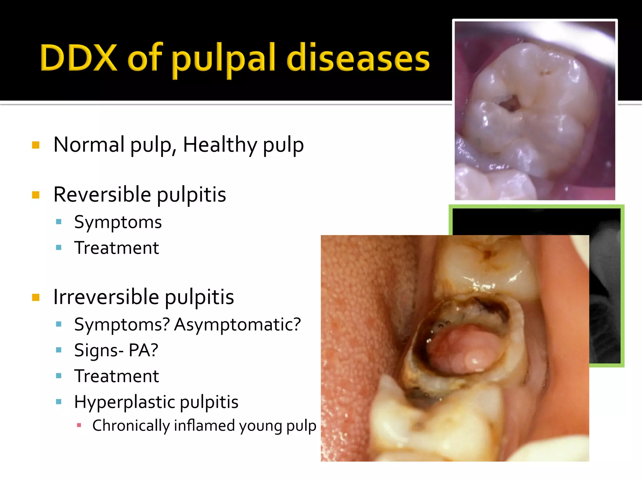 Pulpitis Priapical Pathology of the pulpal and periradicular tissues 2012 2013 | PDF