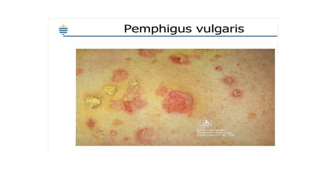 PATHOLOGY OF THE SKIN POWERPOINT PRESENTATION...... Lichen Planus ...