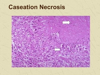 Noncaseating Necrosis Pathology of Tuberculosis12345567778.ppt