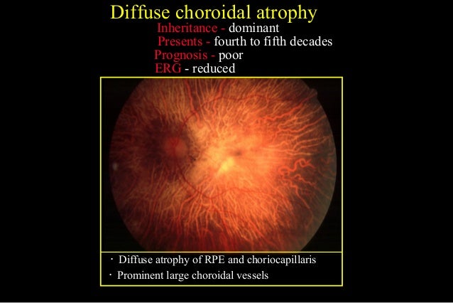 Uveitis Specific Fuchs Heterochromic Non 25 65 Uveitis Specific Fuchs Heterochromic Non 25 65