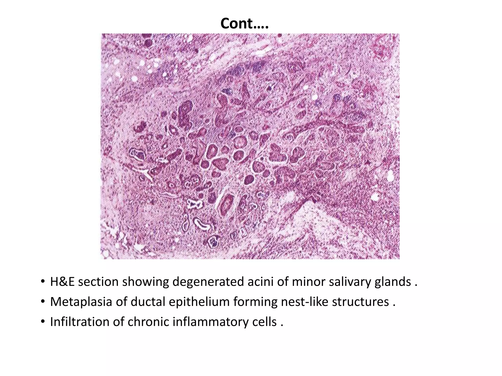 Cont….




• H&E section showing degenerated acini of minor salivary glands .
• Metaplasia of ductal epithelium forming nest-like structures .
• Infiltration of chronic inflammatory cells .
 