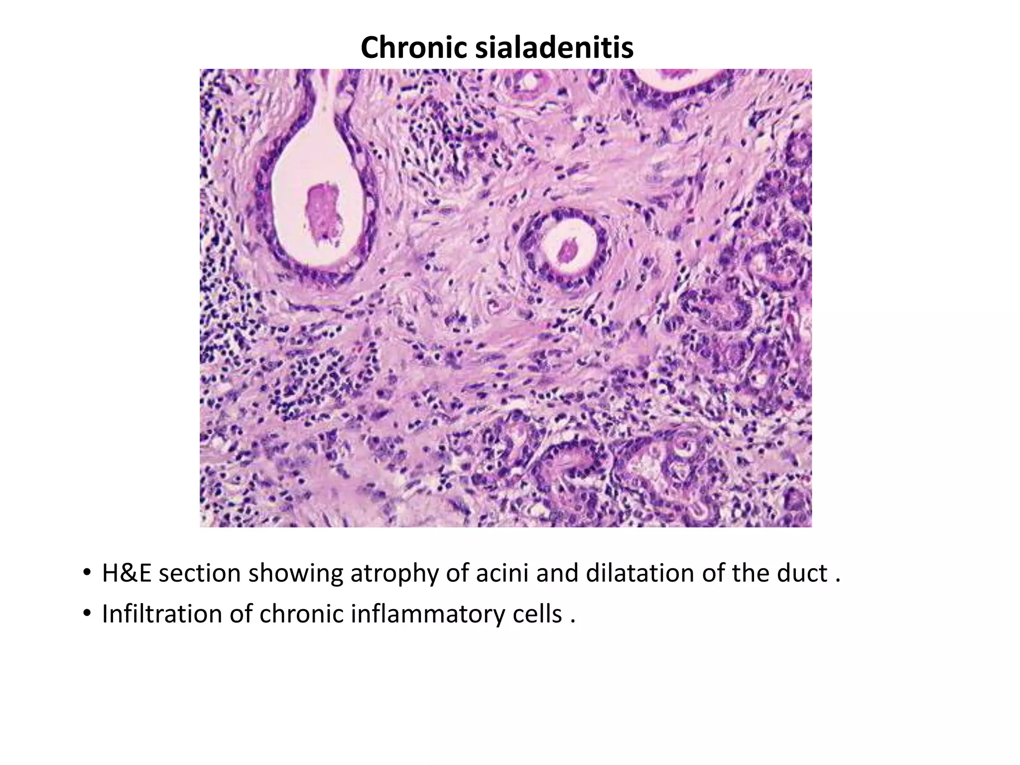 Chronic sialadenitis




• H&E section showing atrophy of acini and dilatation of the duct .
• Infiltration of chronic inflammatory cells .
 