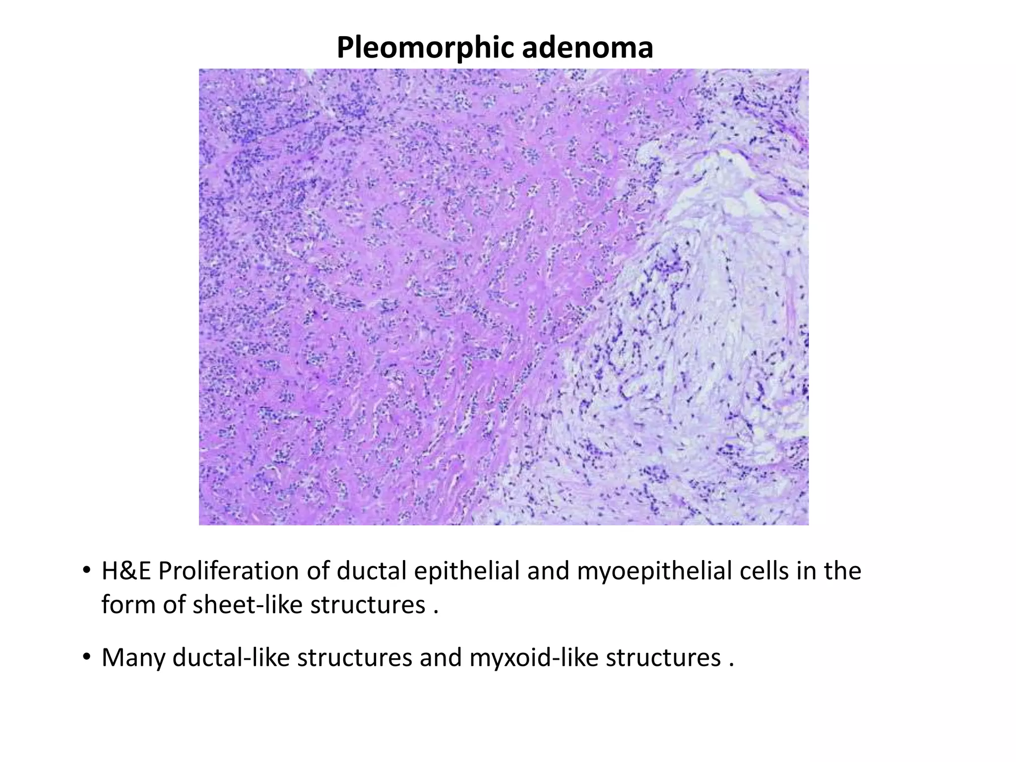 Pleomorphic adenoma




• H&E Proliferation of ductal epithelial and myoepithelial cells in the
  form of sheet-like structures .
• Many ductal-like structures and myxoid-like structures .
 