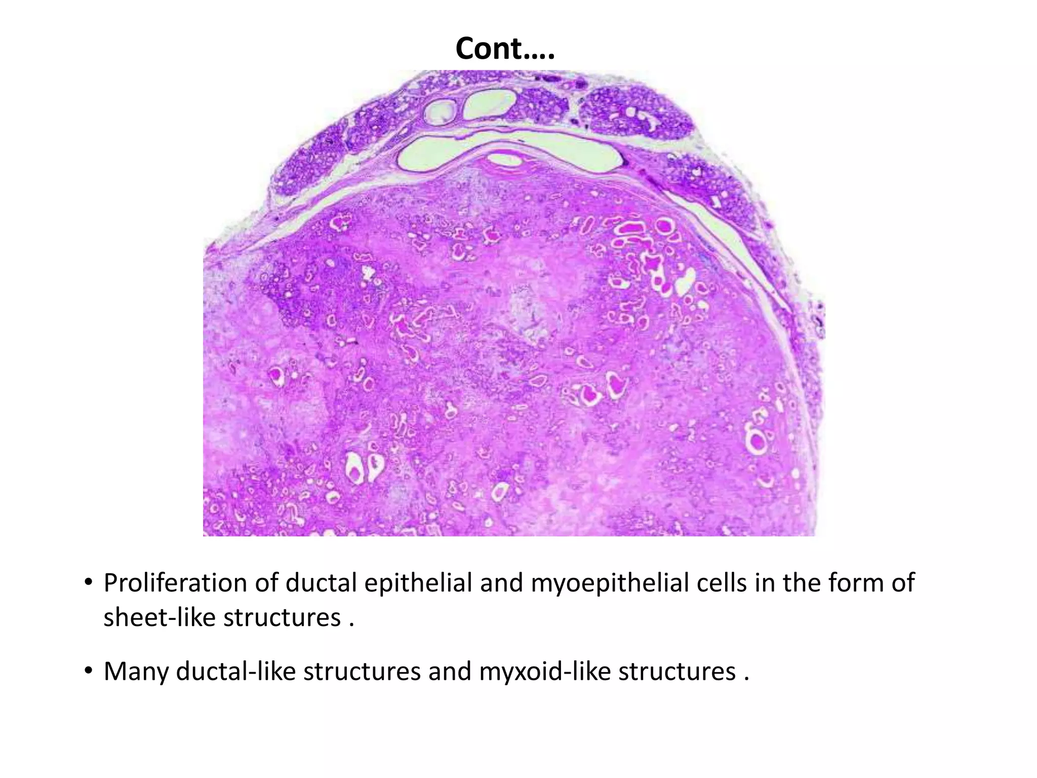 Cont….




• Proliferation of ductal epithelial and myoepithelial cells in the form of
  sheet-like structures .
• Many ductal-like structures and myxoid-like structures .
 