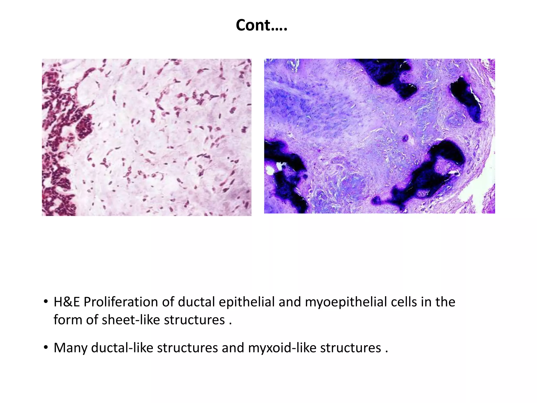Cont….




• H&E Proliferation of ductal epithelial and myoepithelial cells in the
  form of sheet-like structures .
• Many ductal-like structures and myxoid-like structures .
 