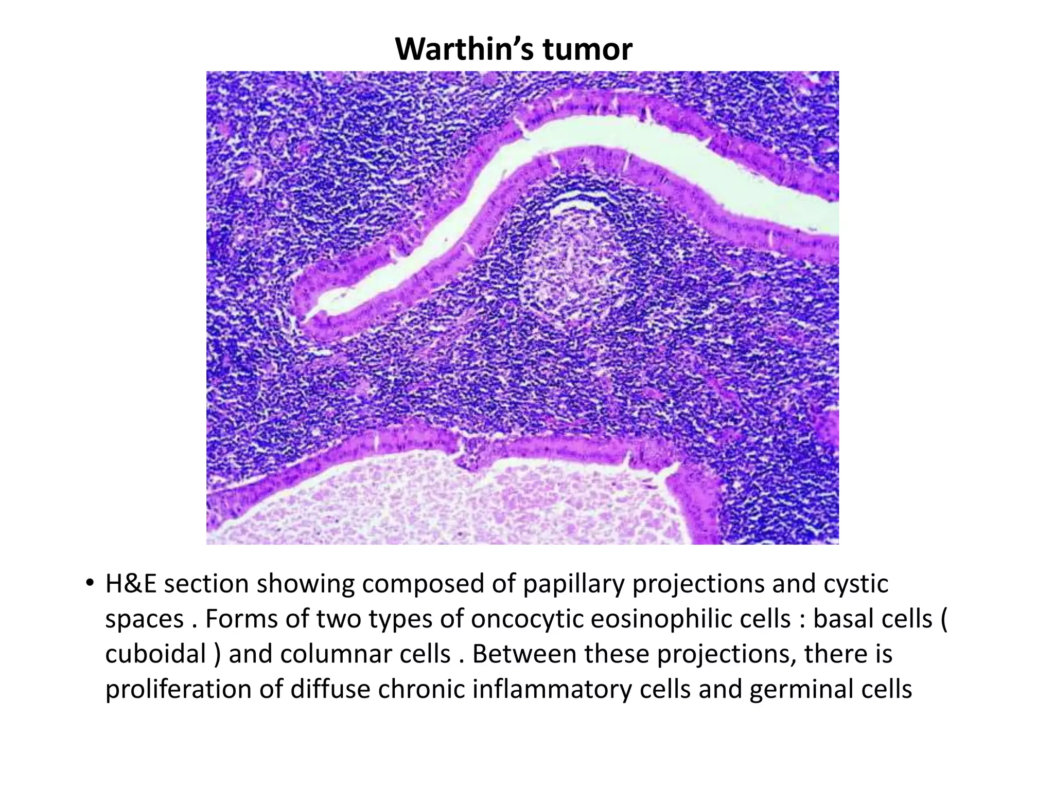 Warthin’s tumor




• H&E section showing composed of papillary projections and cystic
  spaces . Forms of two types of oncocytic eosinophilic cells : basal cells (
  cuboidal ) and columnar cells . Between these projections, there is
  proliferation of diffuse chronic inflammatory cells and germinal cells
 