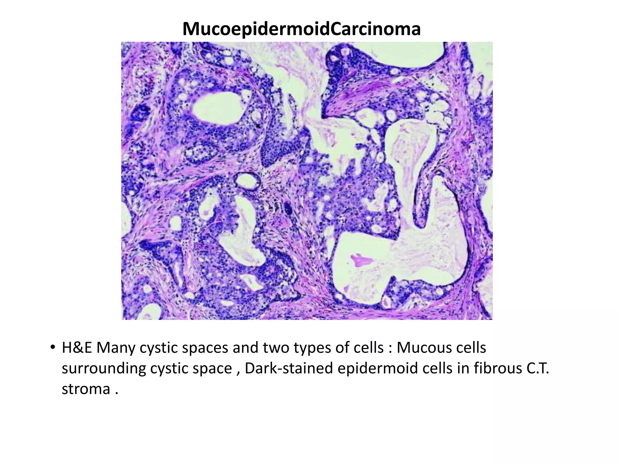 MucoepidermoidCarcinoma




• H&E Many cystic spaces and two types of cells : Mucous cells
  surrounding cystic space , Dark-stained epidermoid cells in fibrous C.T.
  stroma .
 