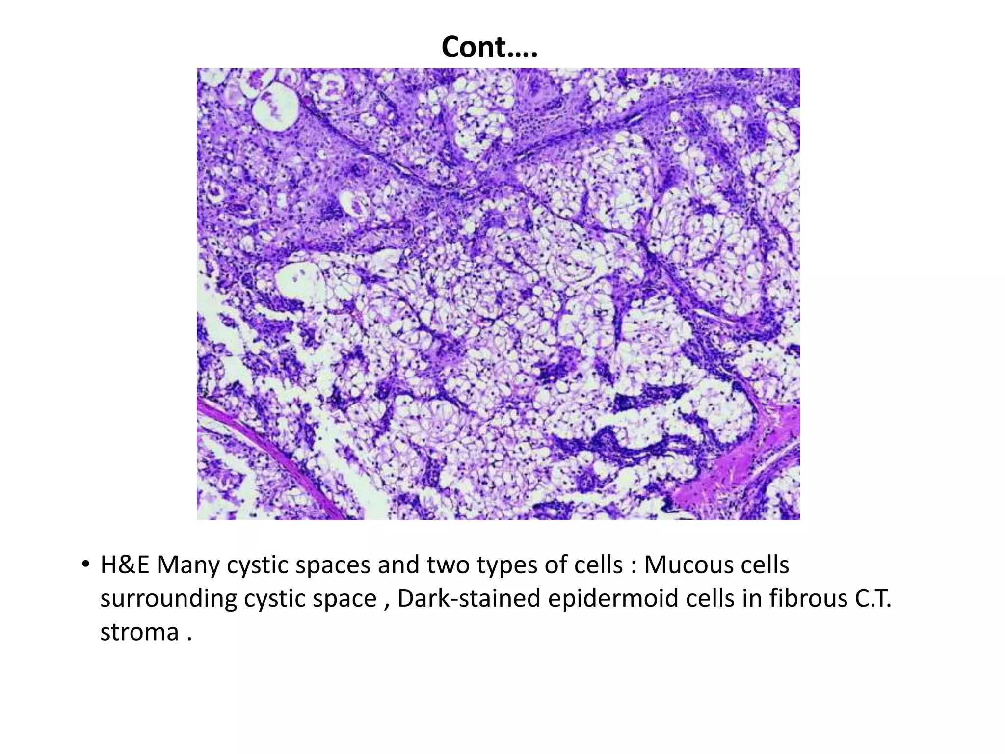 Cont….




• H&E Many cystic spaces and two types of cells : Mucous cells
  surrounding cystic space , Dark-stained epidermoid cells in fibrous C.T.
  stroma .
 