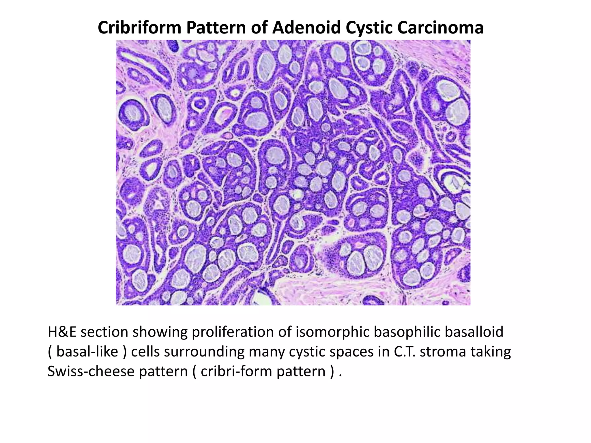 Cribriform Pattern of Adenoid Cystic Carcinoma




H&E section showing proliferation of isomorphic basophilic basalloid
( basal-like ) cells surrounding many cystic spaces in C.T. stroma taking
Swiss-cheese pattern ( cribri-form pattern ) .
 