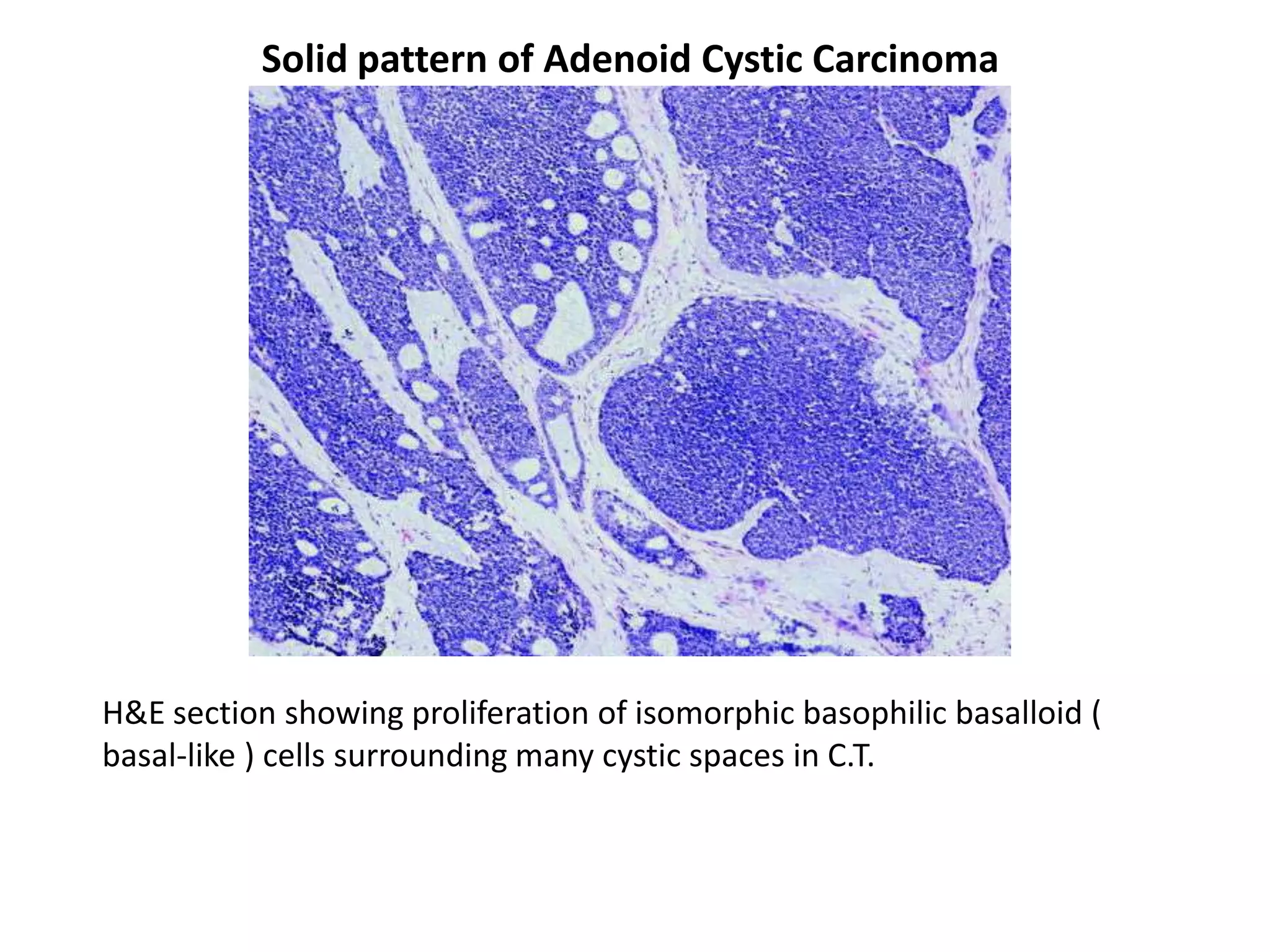 Solid pattern of Adenoid Cystic Carcinoma




H&E section showing proliferation of isomorphic basophilic basalloid (
basal-like ) cells surrounding many cystic spaces in C.T.
 
