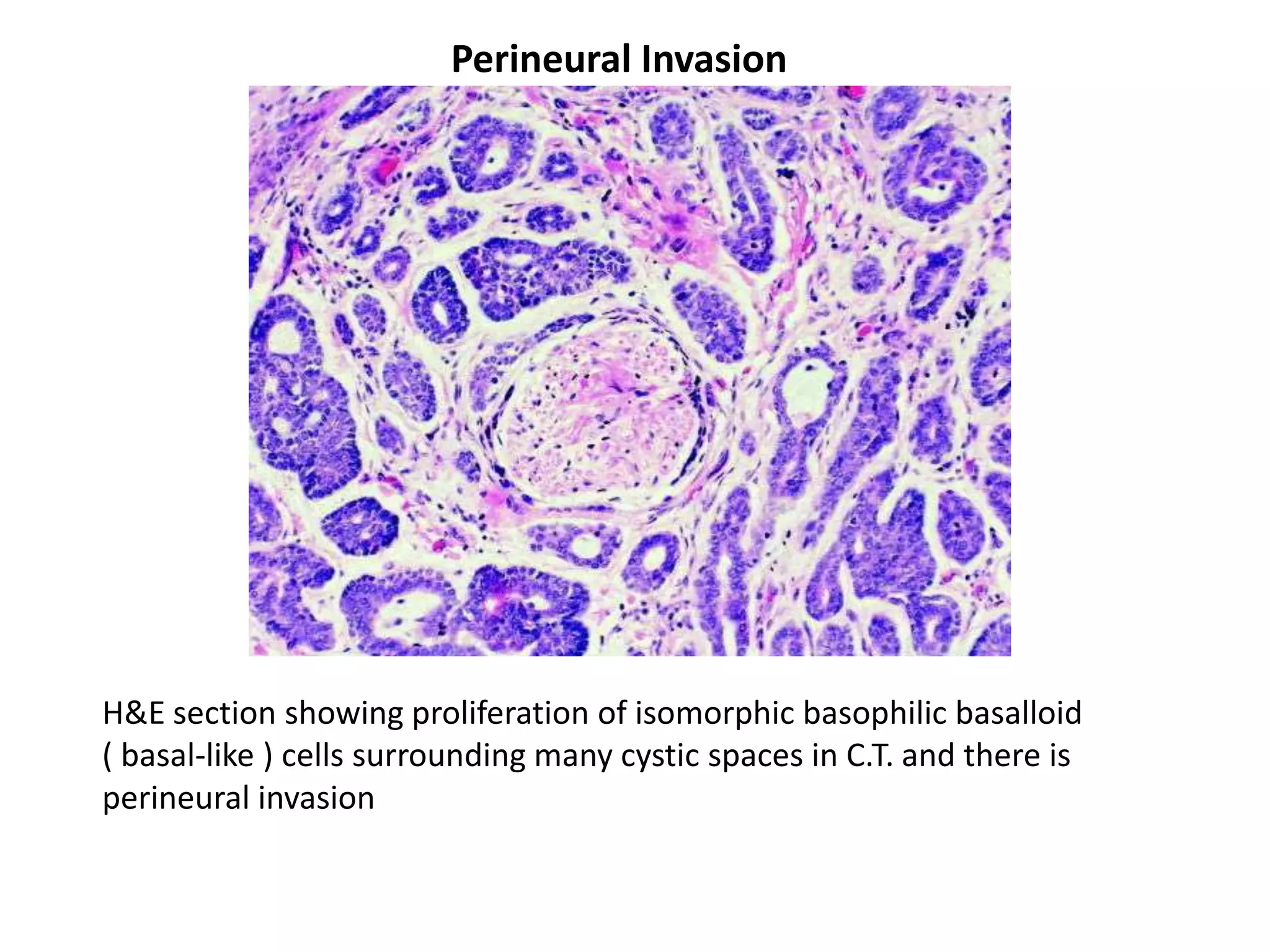 Perineural Invasion




H&E section showing proliferation of isomorphic basophilic basalloid
( basal-like ) cells surrounding many cystic spaces in C.T. and there is
perineural invasion
 
